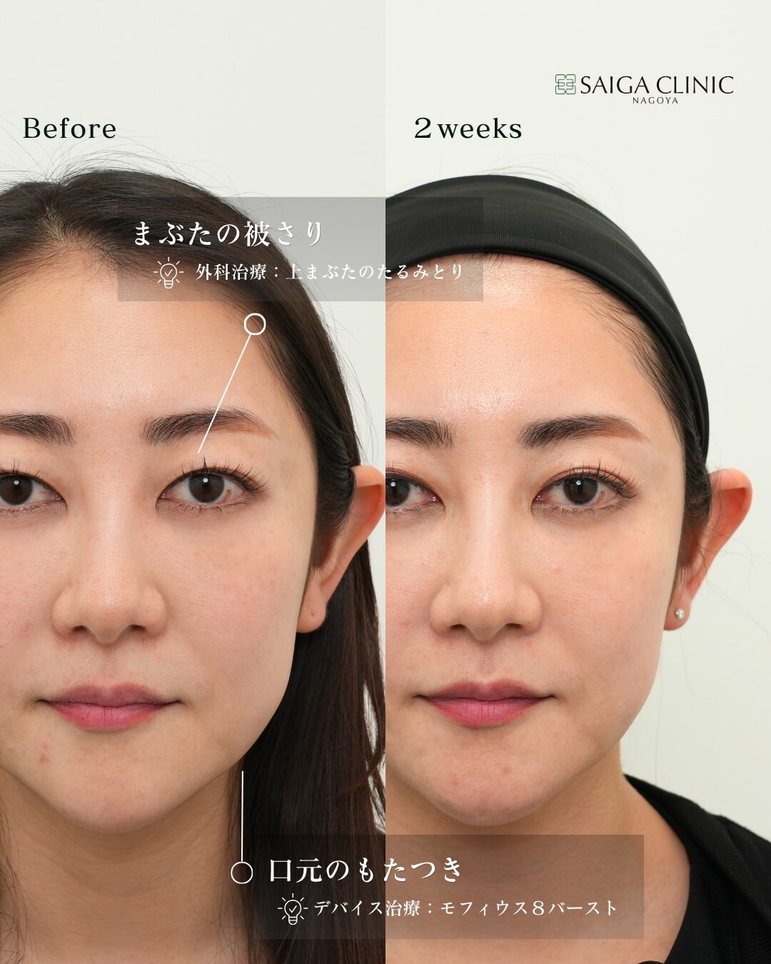 上まぶたのたるみ取りを併用しています。
