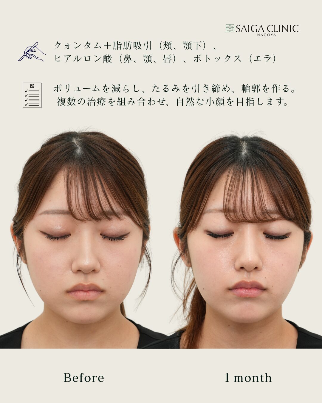 ヒアルロン酸注入（鼻・顎・唇）、ボトックス（エラ）を併用しています。