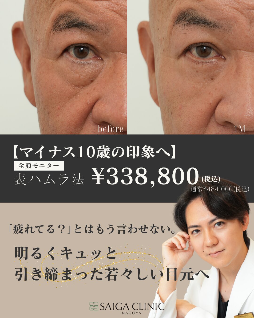 クマ・たるみ治療キャンペーン