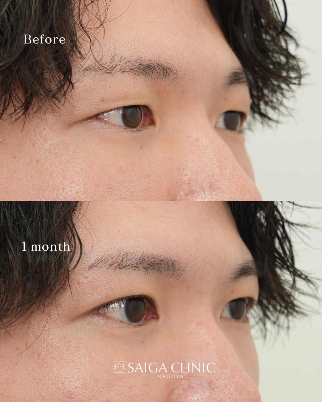 二重埋没（2ループ法） の 3 枚目