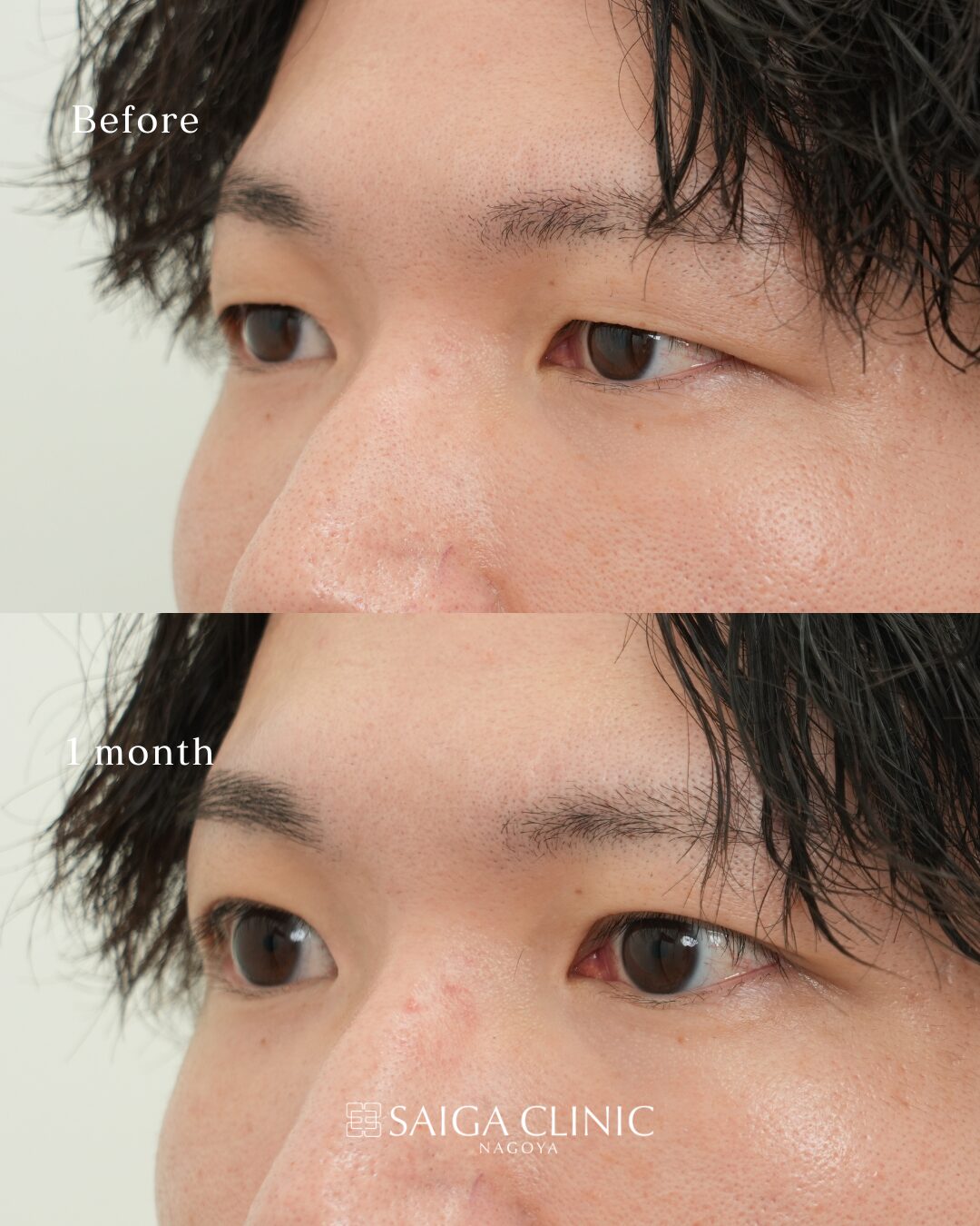 二重埋没（2ループ法） の 4 枚目