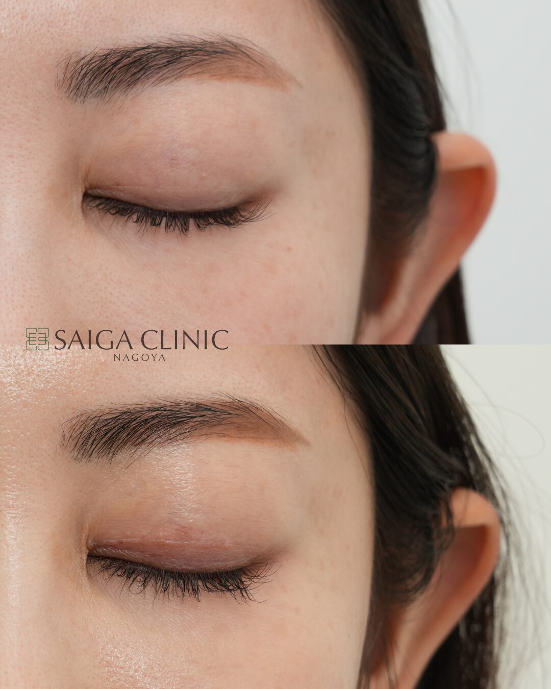 上まぶたのたるみとり の 4 枚目